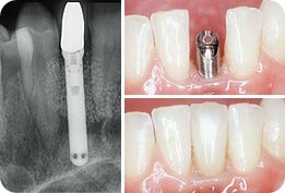 Náhrada pomocou 1 zubného implantátu