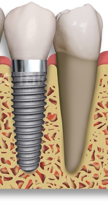 Implantát