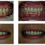 Úprava ďasna – gingivoplastika