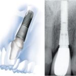 Zubný implantát
