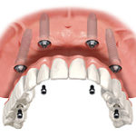 Full mouth reconstruction