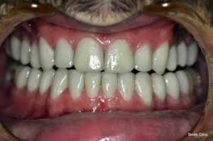 new smile