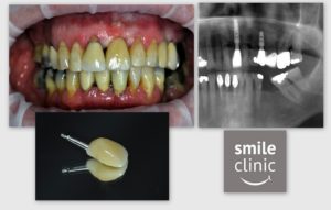 Dental Treatment case - after photo, rtg, implant crown