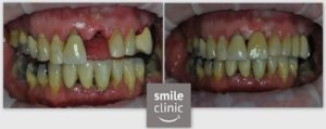 Before and after treatment photograph