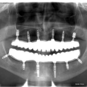 dental implants