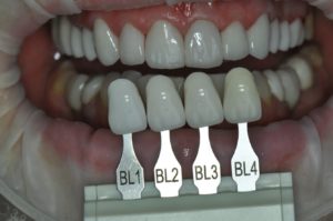 dental crowns