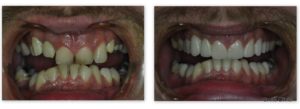 dental implants