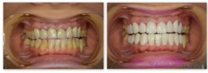 ceramic crowns