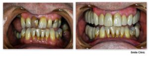 dental implants