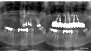 dental implants before and after