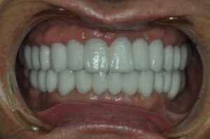 dental implants