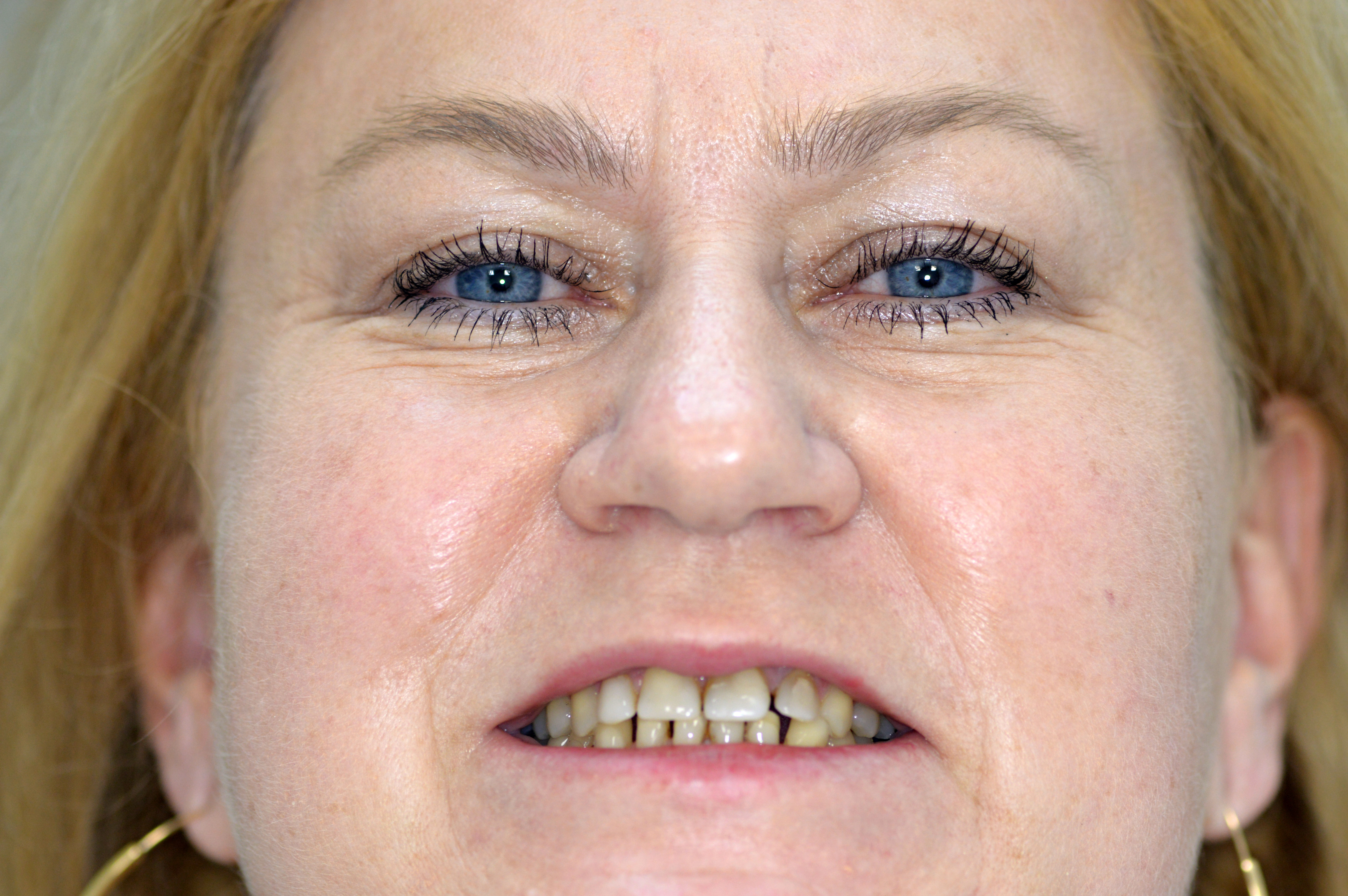 Mrs. Zela´s smile before treatment