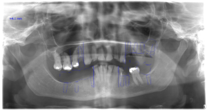 Deborahs X ray BEFORE treatment with dental implants