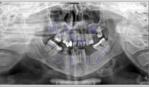 Patients X ray with planned therapy