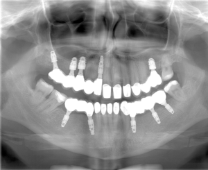 X ray AFTER Treatment