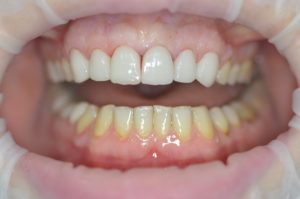 Úsmev slečny Kate PO OŠETRENÍ v Smile Clinic
