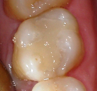 Weiße Füllungen SMILE CLINIC SLOVAKIA