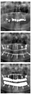 Vrchný snímok zobrazuje chrup pacientky pred ošetrením. Druhý snímok zachytáva nasadené provizóriá. Spodný snímok zobrazuje 12 zubných implantátov na ktorých sú pripevnené celokeramické zubné mostíky.