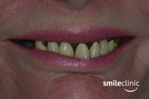 Fotografia úsmevu pacientky PRED OŠETRENÍM