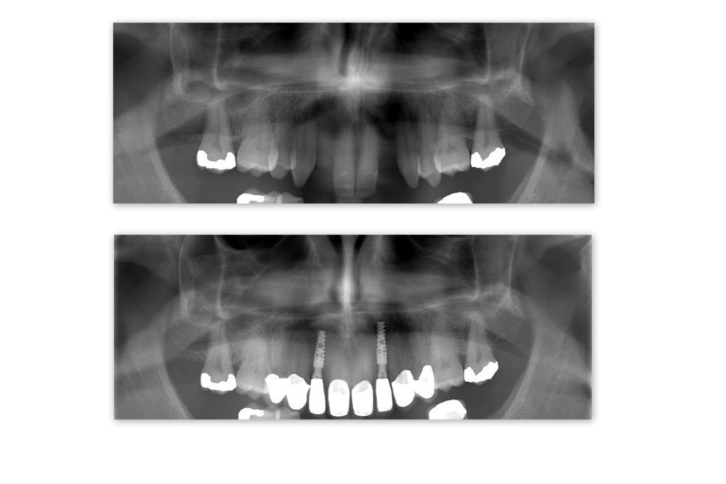 OBRÁZOK HORE: snímok hornej čeľuste pacienta pred ošetrením OBRÁZOK DOLE: snímok hornej čeľuste pacienta po ošetrení