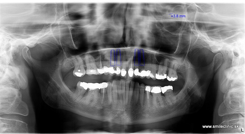 Snímok pred ošetrením, kazuistika fixného zubného mostíka na implantátoch