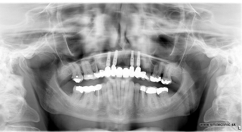 Snímok po ošetrení, kazuistika fixného zubného mostíka na implantátoch